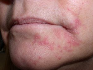 обострение дерматита