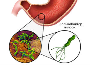 Бактерии в желудке helicobacter pylori