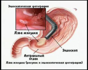 Язва желудка