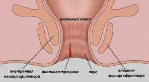 трещина при геморрое